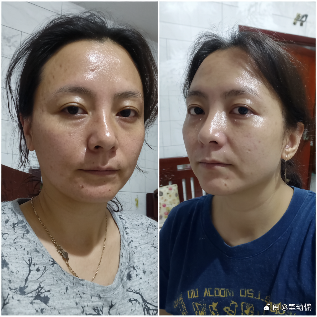 Resultado antes y después - Rosa Villalobos