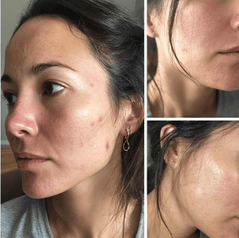 Resultado antes y después - Lucía Herrera